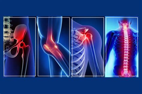 orthocant|Orthocant .